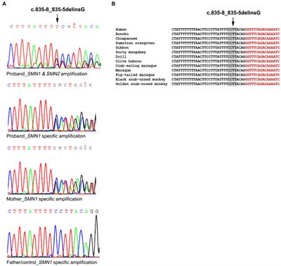 Spinal muscular atrophy type I associated with a novel SMN1 splicing variant that disrupts the expression of the functional transcript